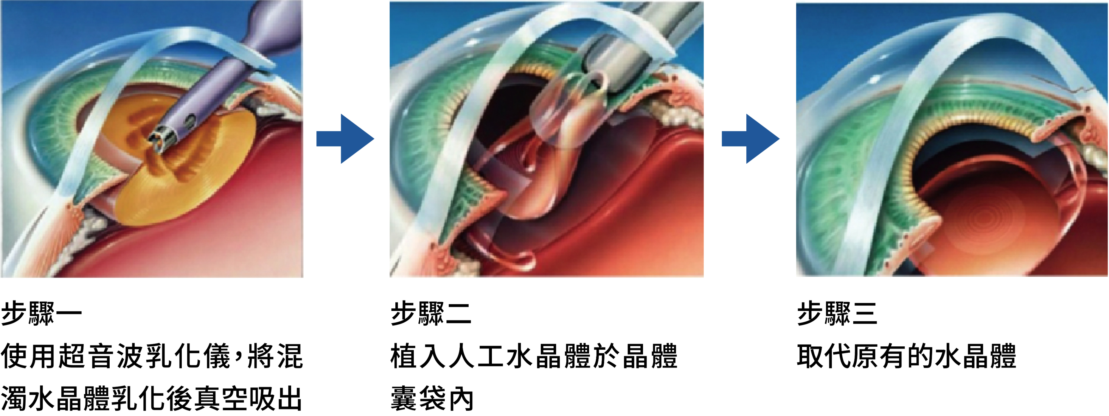 白內障超音波晶體乳化術步驟